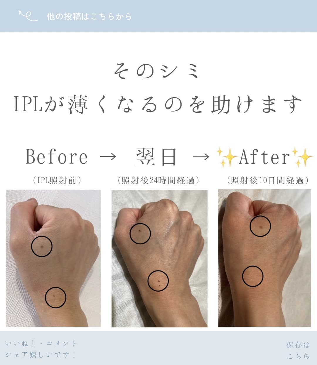 そのシミ、IPLが薄くなるのを助けます。