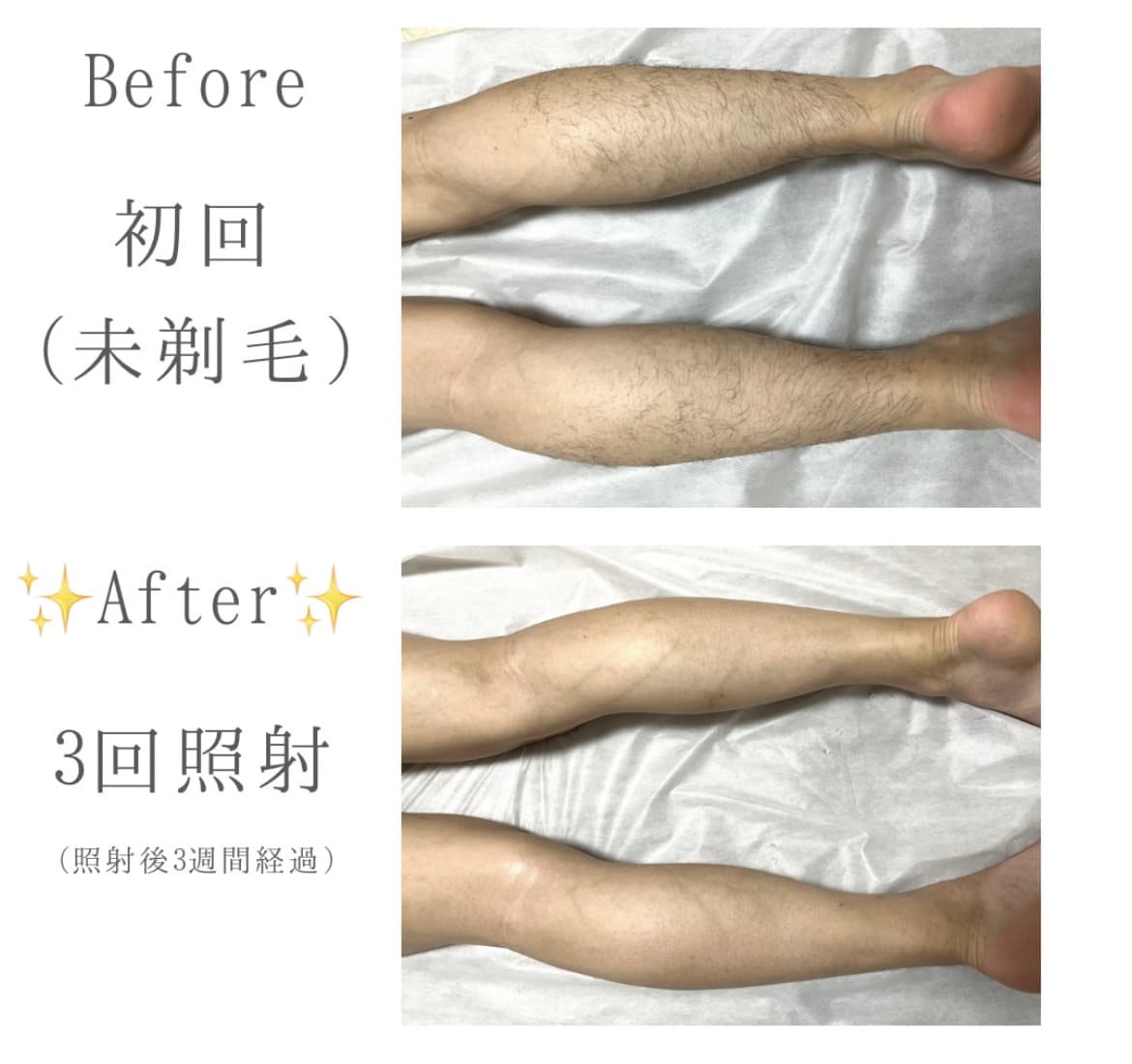 【メンズ】Before/After ひざ下脱毛