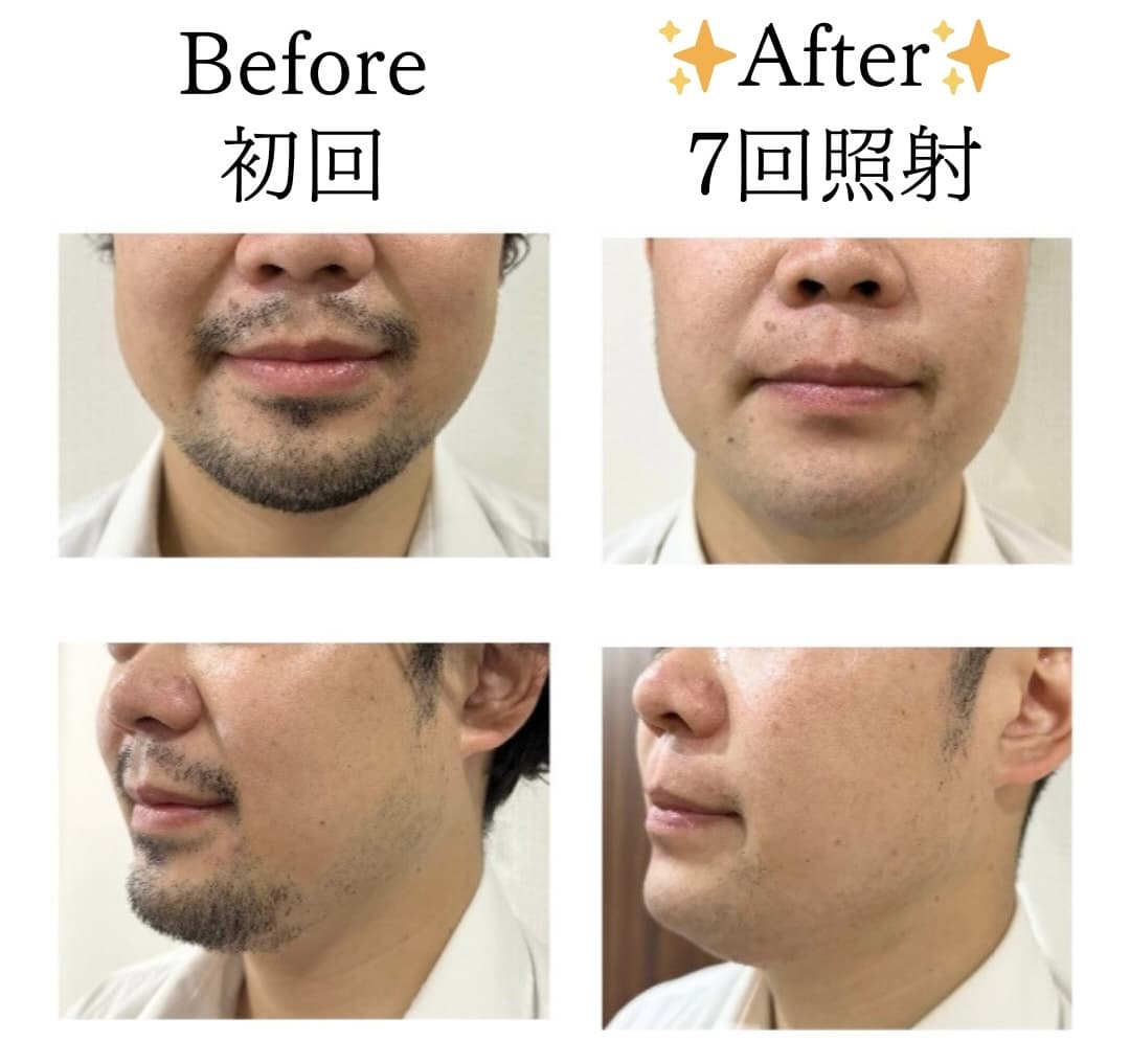 【メンズ】Before/After ヒゲ脱毛