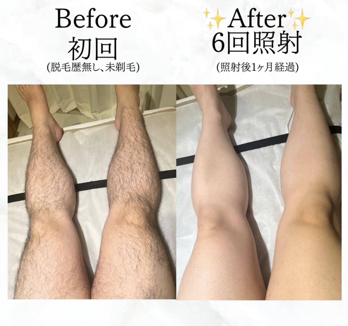 【メンズ】Before/After 足脱毛