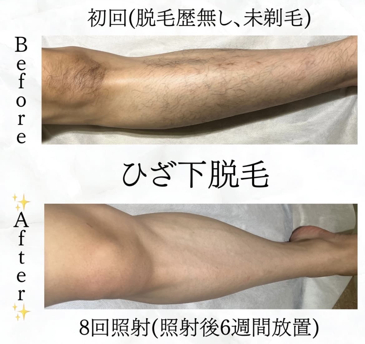 【メンズ】Before/After ひざ下脱毛