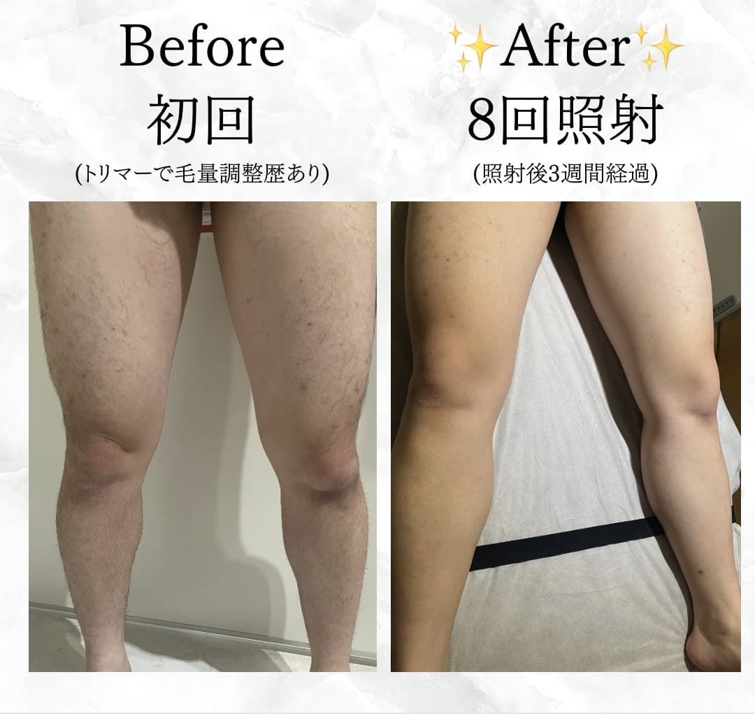 【メンズ】Before/After 脚/足脱毛