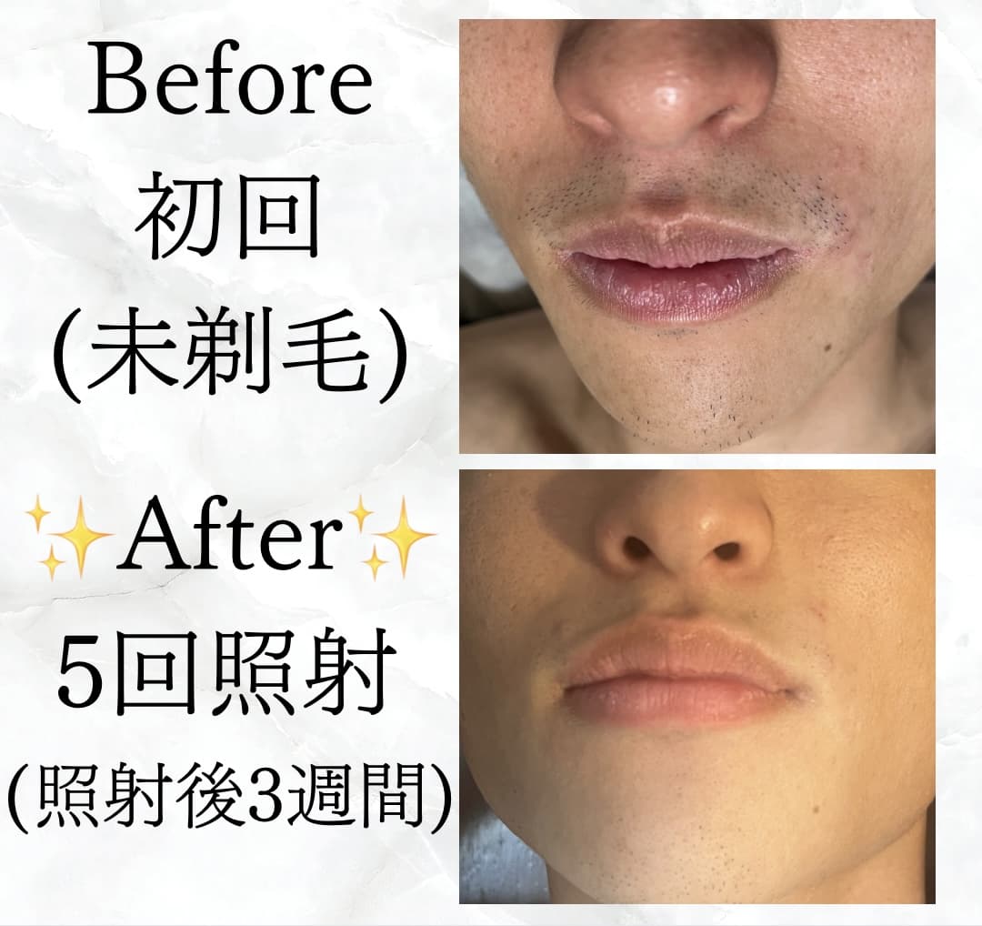 【メンズ】Before/After ヒゲ脱毛