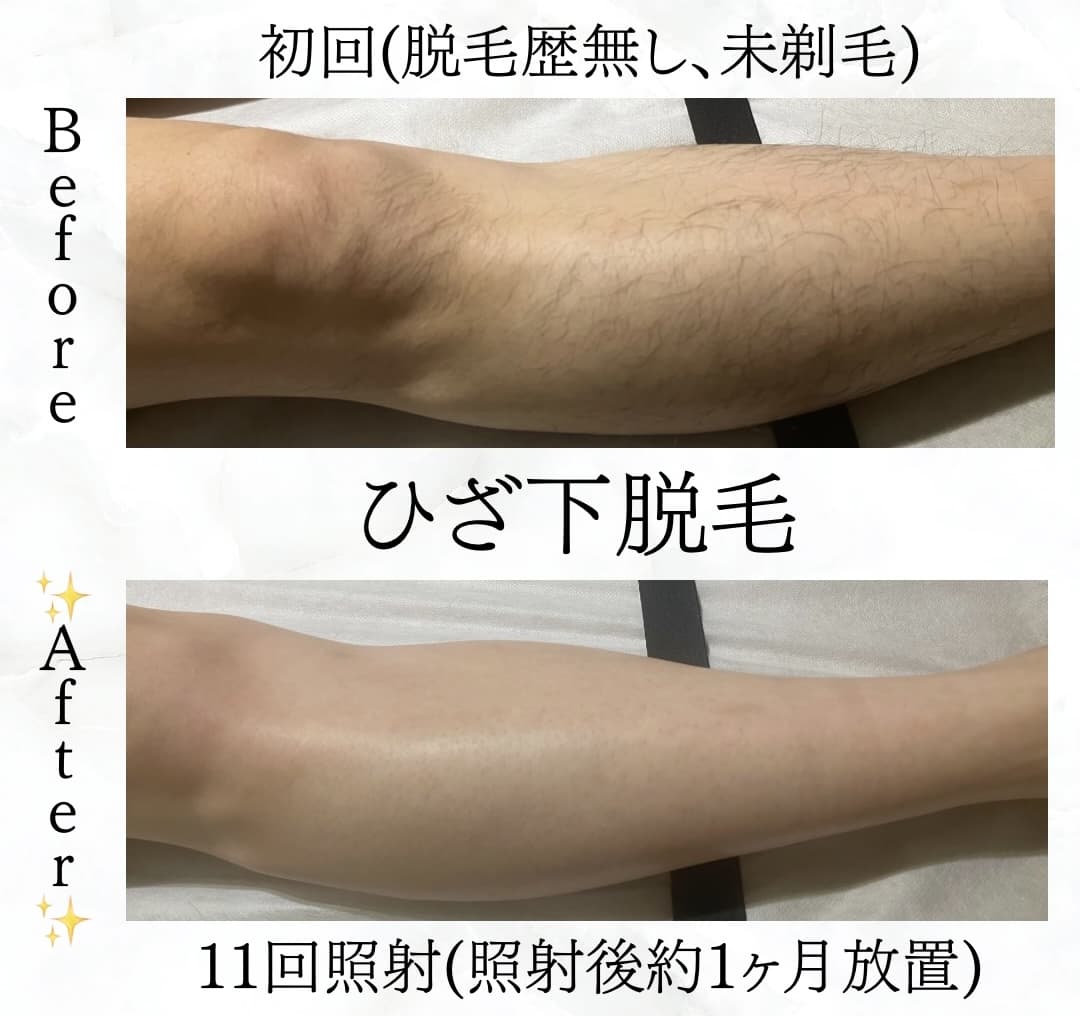 【メンズ】Before/After ひざ下脱毛