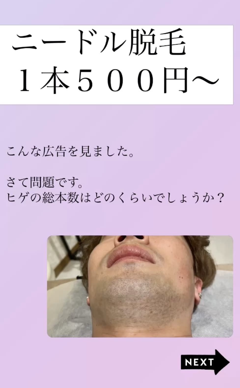 【1本500円の脱毛は安い?】ヒゲの総本数✅