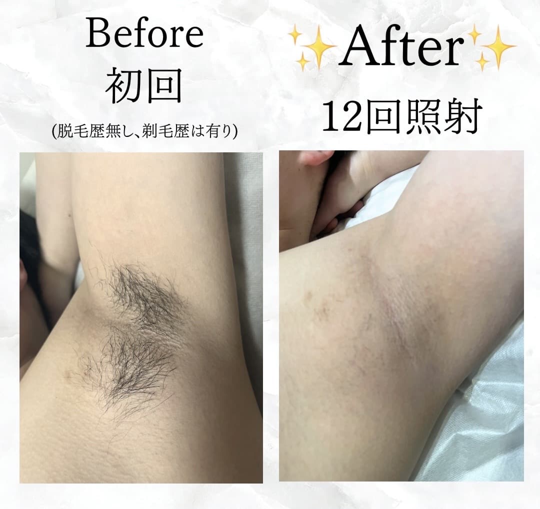【メンズ脱毛】Before/After脇脱毛